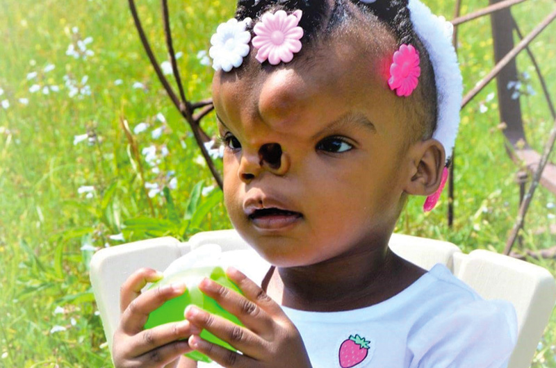 Zoey, before her surgery for a frontal encephalocele