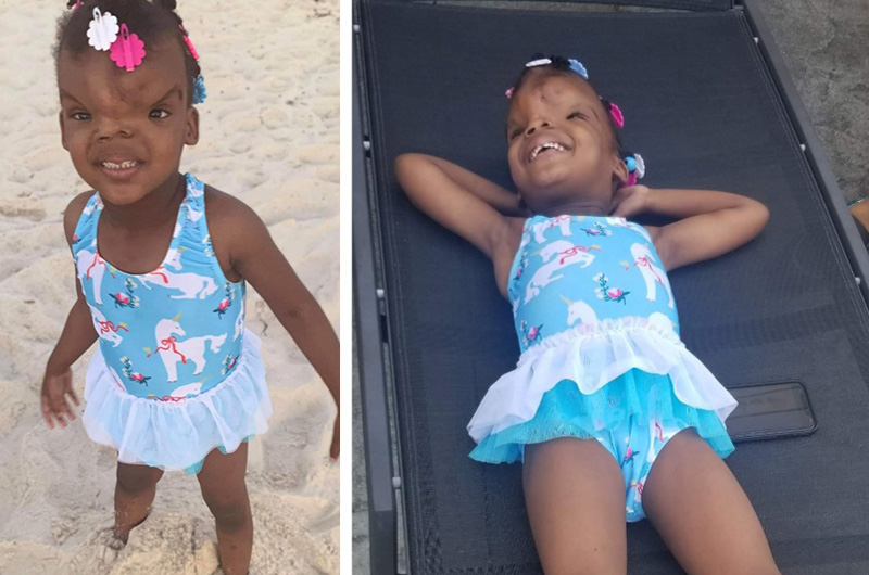 Zoey, who had surgery for a frontal encephalocele, hangs out smiling on the beach.