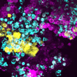 Bone marrow-on-a-chip provides new research directions for Shwachman-Diamond syndrome