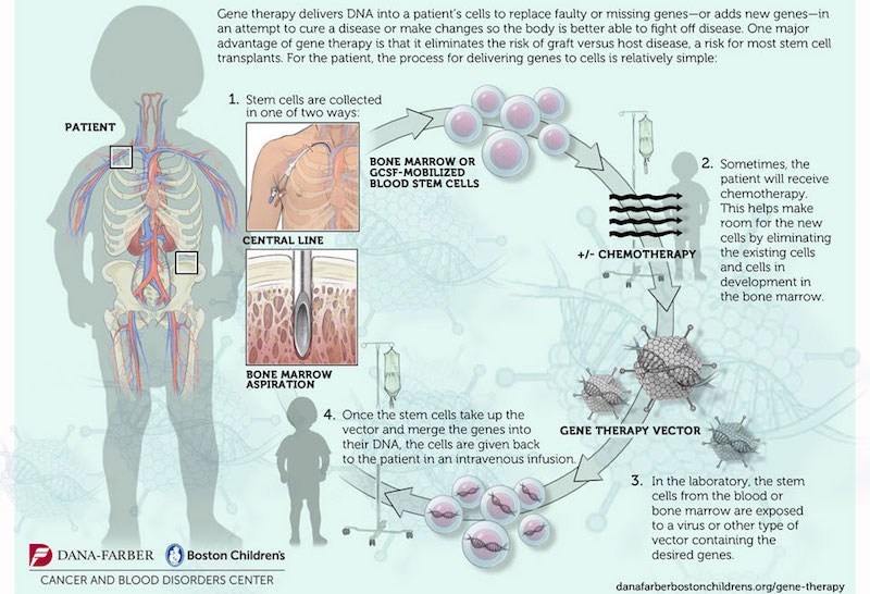 Gene therapy curbs adrenoleukodystrophy Boston Children