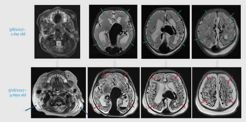 VOGM MRIs