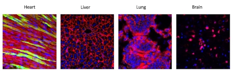 CPVT gene therapy