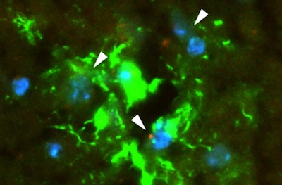 breast-to-brain metastasis begins when exosomes are taken up in the blood brain barrier
