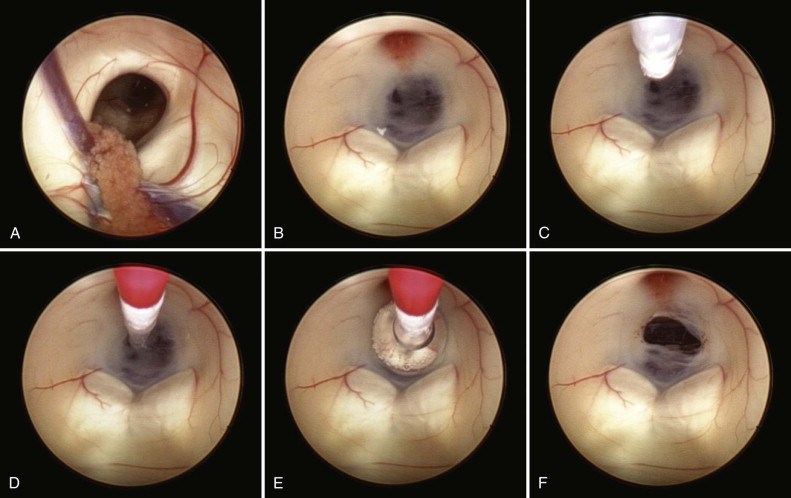 ETV with choroid plexus cauterization