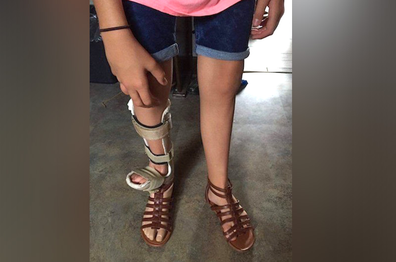 A photo of Maria's first prosthetic foot, pre-amputation. Her natural foot is cradled in a brace that attaches to the prosthesis, giving her the appearance of having two feet on the same leg.