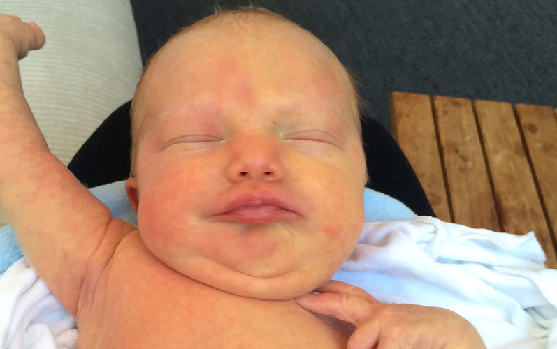 Poppy, who has SDS, as a newborn