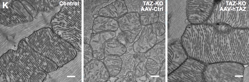 mitochondria in Barth syndrome before and after gene therapy