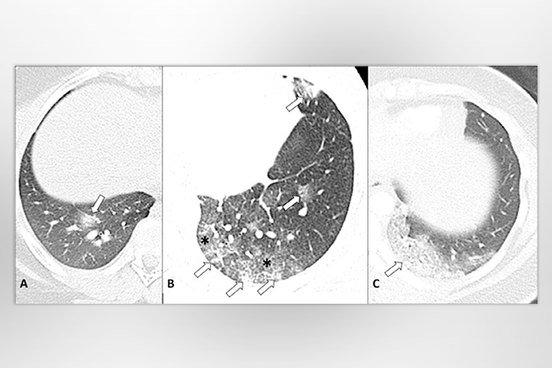 A picture containing 3 images of COVID-19 lung images in child; early, middle, late stage