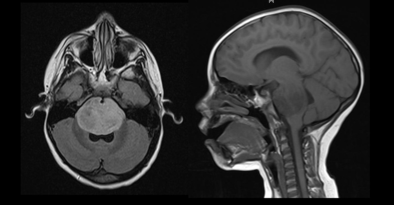 cancer-as-related-to-childhood-brain-stem-glioma-pictures