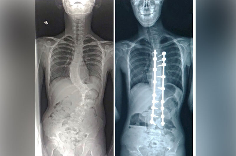 In an x-ray taken before surgery, Jared's mid and lower spine had a severe side-to-side curve. An x-ray taken after spinal fusion surgery shows the rods and screws holding his spine in an upright position.