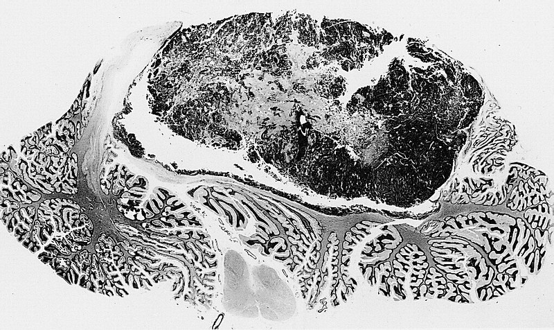 Medulloblastoma