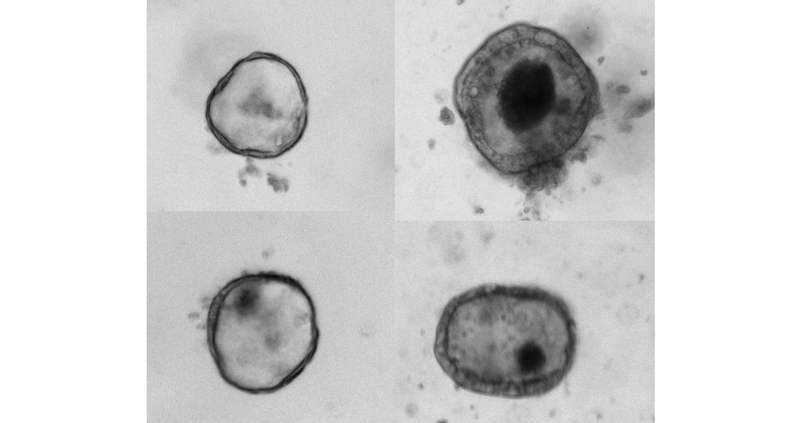 Normal intestinal organoids in contrast to intestinal organoids derived from patients (right) with a newly-discovered gene mutation linked to congenital diarrhea.