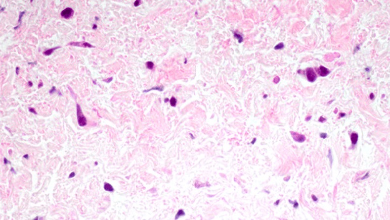 Magnification of pulmonary vein tissue showing signs of pulmonary vein stenosis (