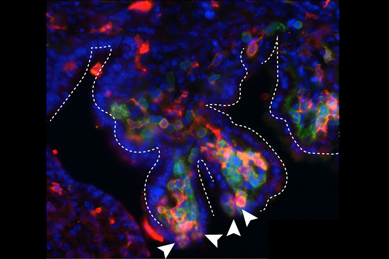 choroid plexus hotspots inflammation