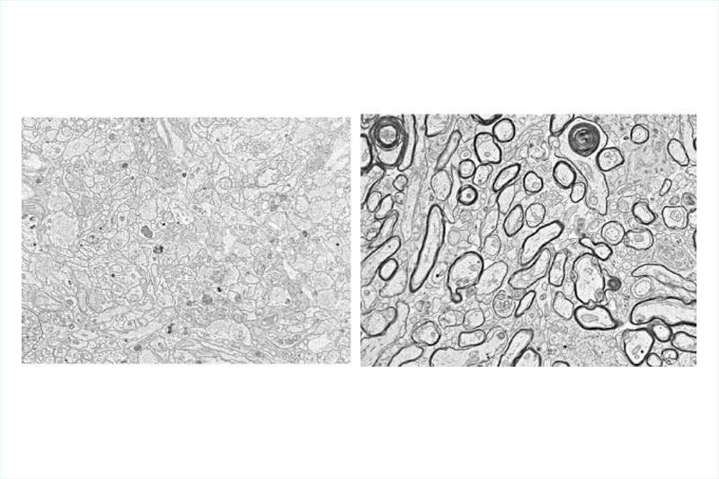 Images of demyelinated regenerated axons and remyelinated regenerated axons of optic nerve cells in mice