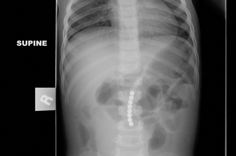 X-ray showing the magnets grouped together in Lainey's intestines